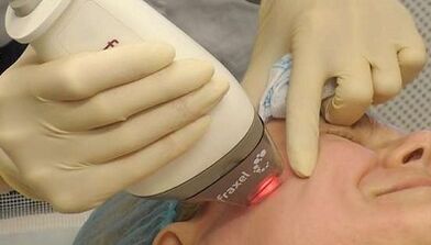 Jak se provádí frakční omlazení pleti