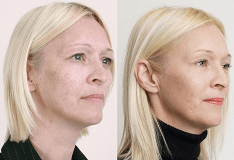 Střední peeling s ovocnými kyselinami