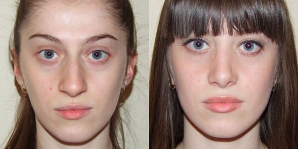 Dívka před a po plazmovém omlazení pleti obličeje