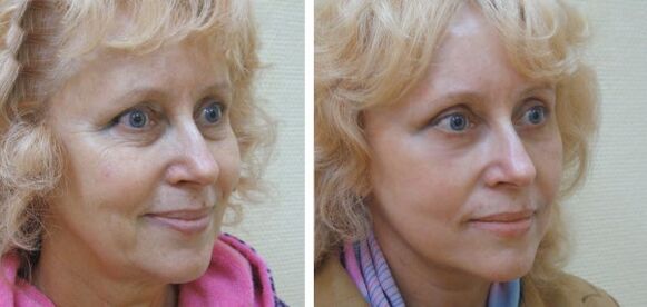 Žena před a po plazmovém omlazení pleti obličeje